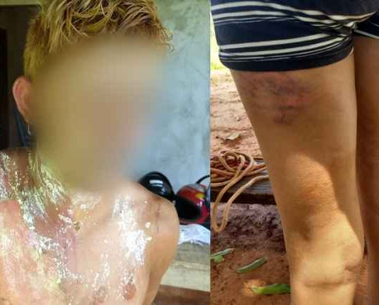 Mulher sequestrada e estuprada pelo ex queima homem para se livrar de torturas